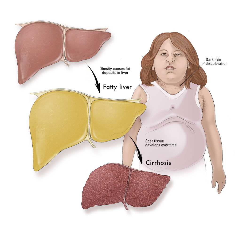 схема получения жирового цирроза